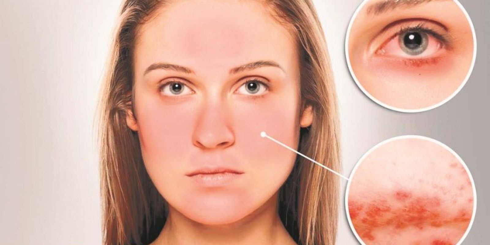 Tratamiento antibiótico para la rosácea cómo es Tratamiento antibiótico para la rosácea cómo es