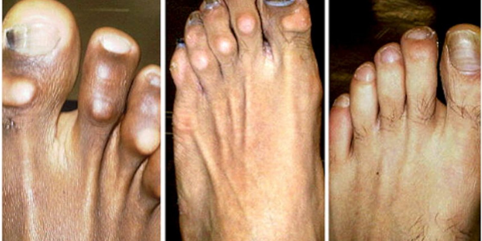 ¿Cómo son maltratados los pies de los futbolistas? Publimetro México